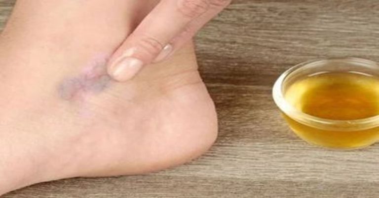 Gel protiv proširenih vena Varcosin